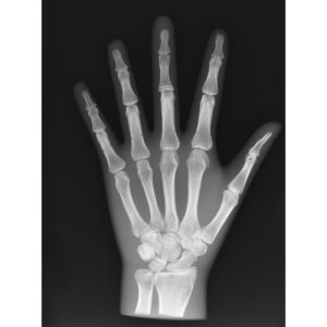 Erler Zimmer X-ray Phantom Hand, Opaque