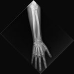 Erler Zimmer X-ray Phantom Lower Arm (Opaque)