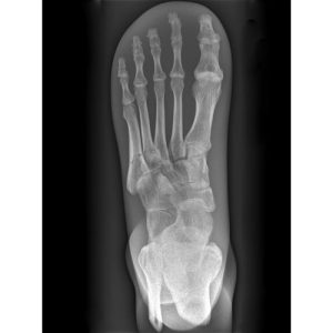 Erler Zimmer X-ray Phantom Foot (Opaque)
