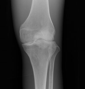 Erler Zimmer X-ray Phantom Knee (Opaque)
