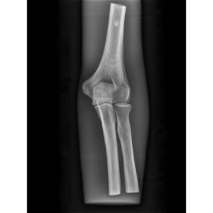 Erler Zimmer X-ray Phantom Elbow (Opaque)