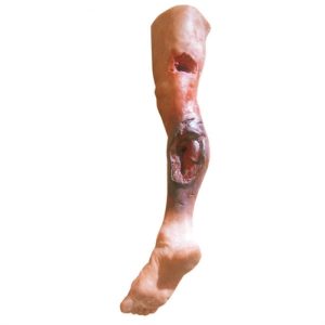 Erler Zimmer Emergency Leg